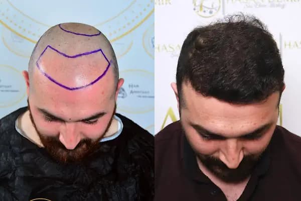 HASAN DEMİR SAÇ EKİMİ ANKARA - Saç Transplantasyonu Kliniği - Ankara Çankaya