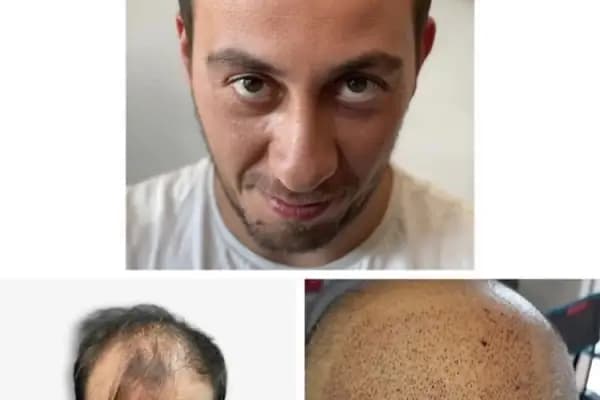 Saç Ekim Merkezi - Saç Transplantasyonu Kliniği - Ankara Altındağ