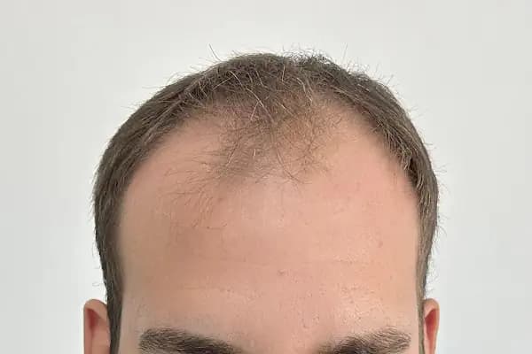 İbrahim Erayhan-Saç Ekimi-Bursa Tıp Merkezi - Hairtransplant Clinic - Saç Transplantasyonu Kliniği - Bursa Gürsu