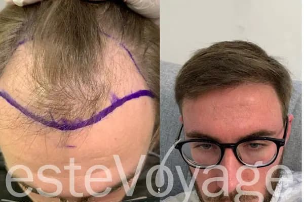EsteVoyage - Saç Transplantasyonu Kliniği - İstanbul Ataşehir