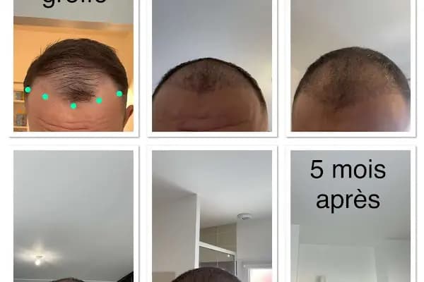 BELLA HAIR - Greffe de Cheveux- DHI-FUE - Saç Transplantasyonu Kliniği - İstanbul Beylikdüzü