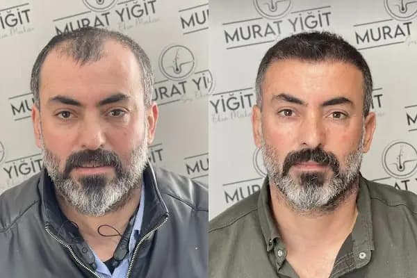 Gaziantep Saç Ekimi - Murat Yiğit - Sağlık ve Güzellik Merkezi - Gaziantep Şehitkamil