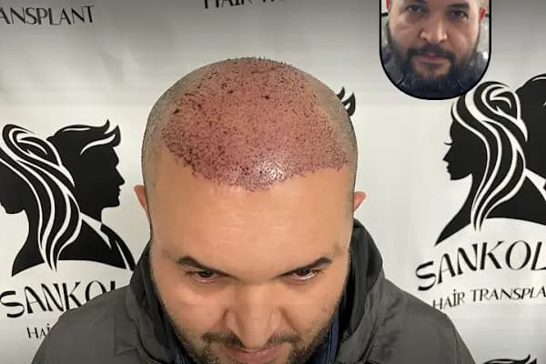 Sankolis İstanbul Hair Transplant - Saç Ekimi İstanbul - Saç Transplantasyonu Kliniği - İstanbul Ataşehir