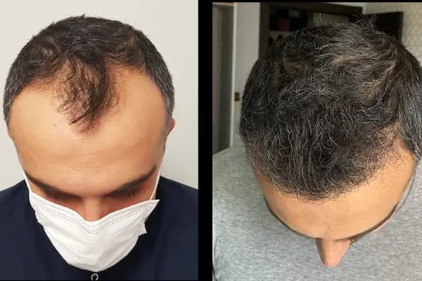 Клиника по пересадке волос Анталья VIVAEST - Saç Ekimi - Hair Transplant Antalya - Saç Yenileme Hizmeti - Antalya Muratpaşa