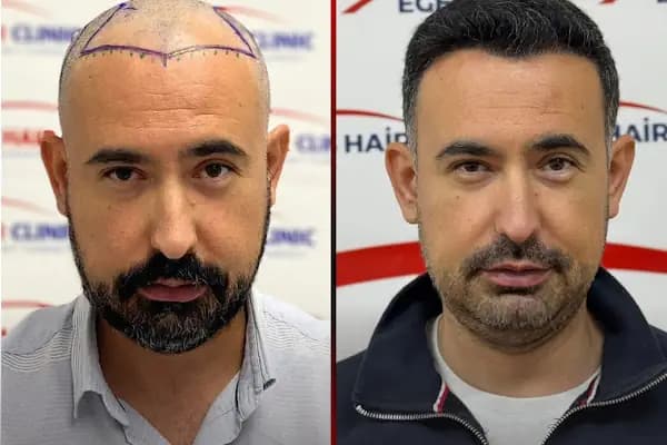 Balıkesir Saç Ekim Merkezi - Saç Yenileme Hizmeti - Balıkesir Burhaniye