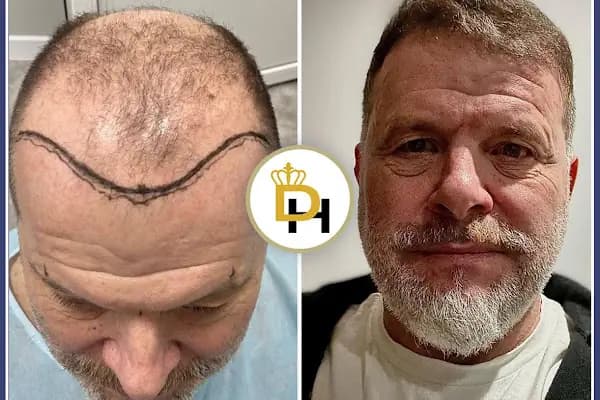 Gaziantep Fue Saç Ekim - Docshair Arif UĞUR - Saç Yenileme Hizmeti - Gaziantep Araban