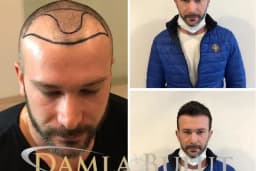 Damlabuluthairtrans Saç Ekim Kliniği
