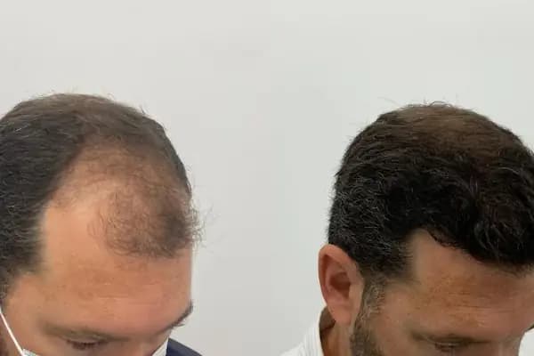 Allina Hair Clinic / Saç Ekimi ve Saç Sorunları Merkezi - Saç Transplantasyonu Kliniği - İstanbul Beşiktaş