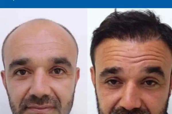 MEDAR Sakarya Saç Ekimi MEDARHAIR - Saç Transplantasyonu Kliniği - Sakarya Adapazarı