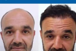 MEDAR Sakarya Saç Ekimi MEDARHAIR