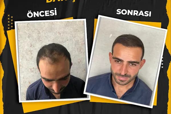 FBK Danışmanlık - Saç Yenileme Hizmeti - Şanlıurfa Karaköprü