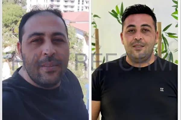 ERAY FESLİGİL PROTEZ SAÇ ANTALYA - Saç Yenileme Hizmeti - Antalya Muratpaşa