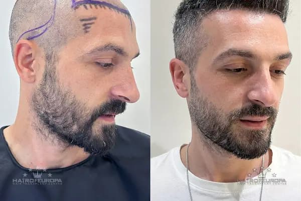 Hair of Europa - Saç Transplantasyonu Kliniği - İstanbul Ataşehir
