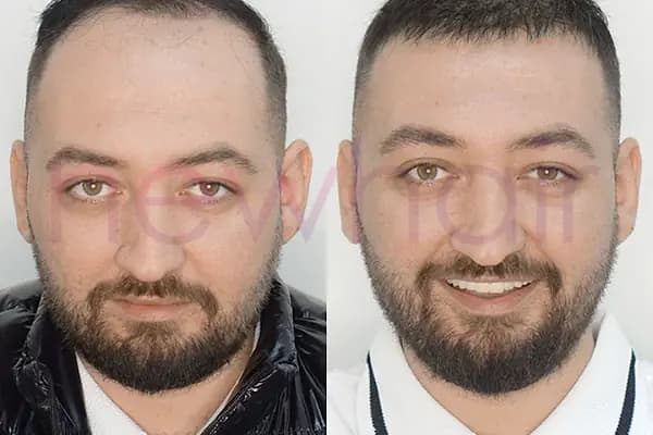 Newhair İzmir, Protez saç, Saç Protezi, Saç Ekimi, Kemoterapi, Hair Replacement, Toupee - Saç Yenileme Hizmeti - İzmir Konak