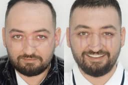 Newhair İzmir, Protez saç, Saç Protezi, Saç Ekimi, Kemoterapi, Hair Replacement, Toupee