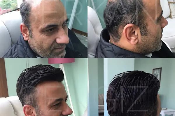 serkan cengiz protez saç merkezi adana - Kuaför - Adana Seyhan