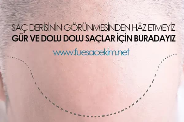 Gaziantep Saç Ekim&amp;Protez - Fue Estetik - Estetik Cerrah - Gaziantep Şehitkamil