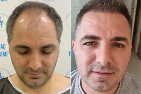 Özel Serena Polikliniği | Lazer Epilasyon | Buz Lazer | Botoks | Saç Ekimi | Dudak Dolgusu | Gençlik Aşısı - Epilasyon Hizmetleri - İzmir Bornova