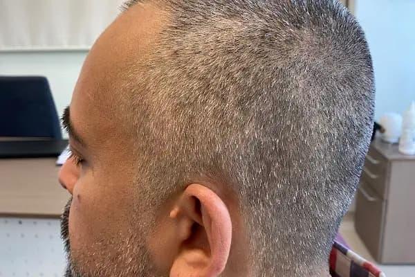 Bilyana Hair Clinic Saç Ekim Merkezi - Saç Transplantasyonu Kliniği - Antalya Muratpaşa