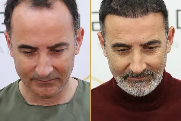 For Legend Hair Transplant - Saç Transplantasyonu Kliniği - İstanbul Üsküdar