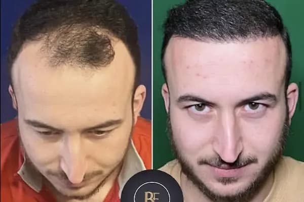Saç Ekim Merkezi | Buğra Erdal ® Hastane Saç Ekimi | Ankara Saç Ekimi PRP Mezoterapi - Saç Transplantasyonu Kliniği - Ankara Çankaya
