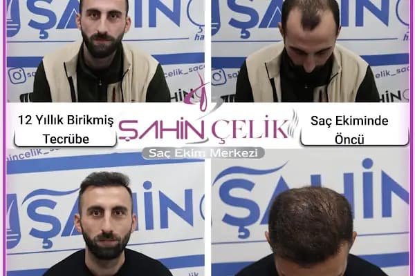 LifeHair Ankara | Saç Ekimi Ankara | Şahin Çelik | Ankara Saç Ekim Merkezi - Saç Transplantasyonu Kliniği - Ankara Çankaya