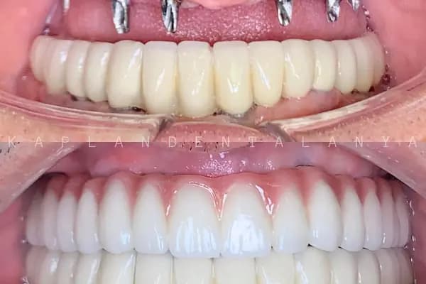 Kaplan DentAlanya Ağız ve Diş Sağlığı Polikliniği - Diş Kliniği - Antalya Muratpaşa