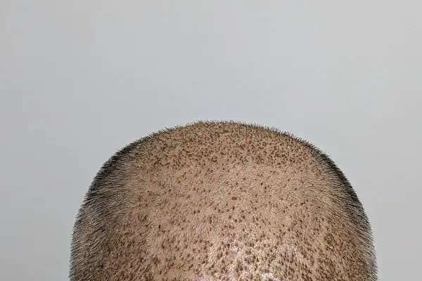 Double Hair Center | Saç Ekim Merkezi - Saç Yenileme Hizmeti - İstanbul Ümraniye