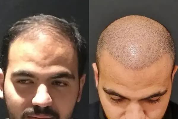 May Hair Center - Saç Transplantasyonu Kliniği - İstanbul Beylikdüzü