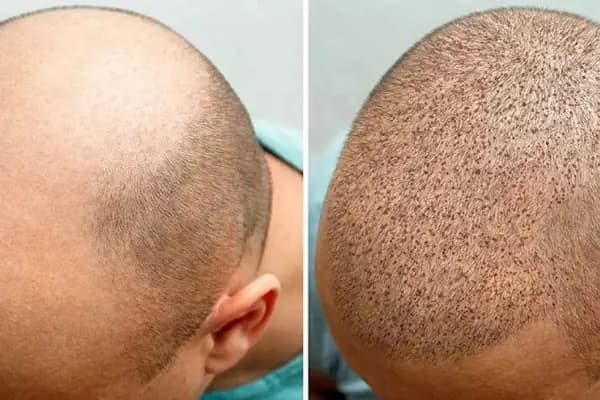 Trabzon Saç Ekim Merkezi - Hair Clinic - Saç Transplantasyonu Kliniği - Trabzon Ortahisar