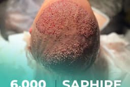 Carla Clinic Saç Ekim Merkezi Avcılar