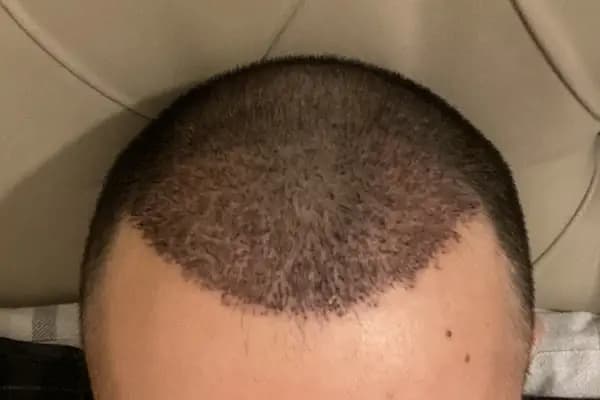 SE Hair Clinic | Hair Transplant Antalya - Saç Transplantasyonu Kliniği - Antalya Muratpaşa
