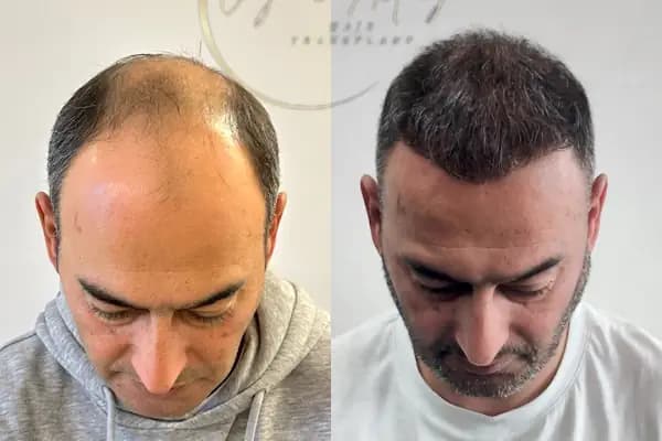 Ozan Ablay Hair Transplant - Sağlık Merkezi - İzmir Buca