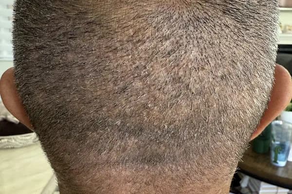 Vera Clinic | Hair Transplant Clinic in Turkey - Saç Transplantasyonu Kliniği - İstanbul Kartal