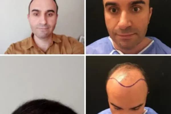 Emphair Hair Transplantation Premium Istanbul Clinic - Saç Ekimi - EMPCLINICS - Saç Transplantasyonu Kliniği - İstanbul Küçükçekmece