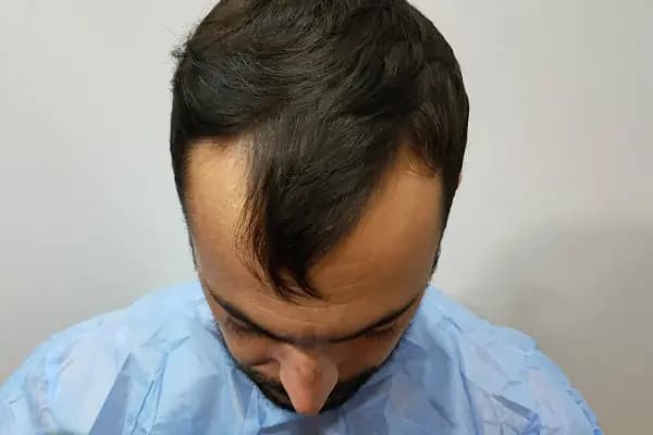 Egemen Güdül Hair Clinic Ankara Saç Ekim Merkezi Ankara - Saç Transplantasyonu Kliniği - Ankara Çankaya