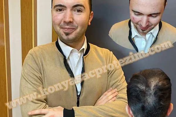 Nafiz Keskin Protez Saç Kliniği - Güzellik Salonu - Konya Karatay