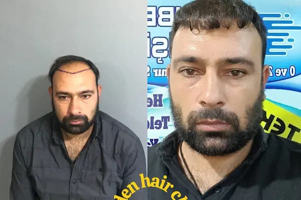 Estetik &amp; güzellik Şanliurfa Saç Ekim Merkezi /زراعة الشعر في أورفا - Sağlık ve Güzellik Merkezi - Şanlıurfa Haliliye