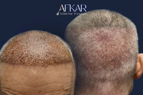 Turkish Hair Transplants - AFKAR - Hair Transplant Turkey, Istanbul - Saç Transplantasyonu Kliniği - İstanbul Şişli