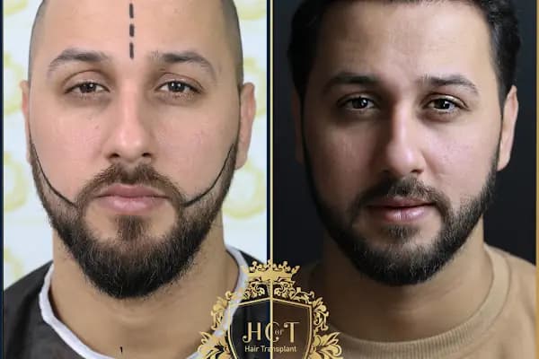 HIV Positive Hair Transplant in Turkey - Saç Transplantasyonu Kliniği - İstanbul Bayrampaşa
