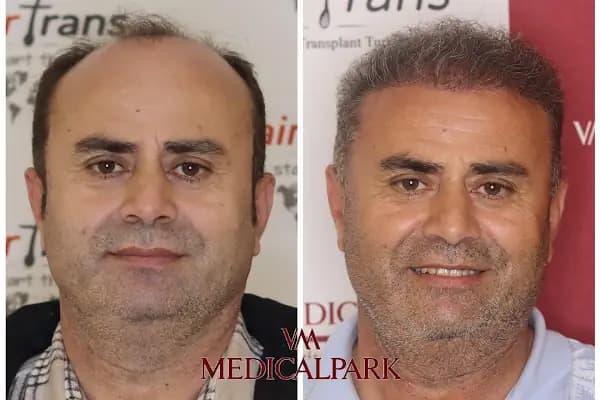 Hair Trans - Samsun Saç Ekimi - Saç Transplantasyonu Kliniği - Samsun Bafra