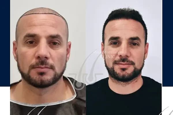 Hair Information Clinic - Saç Ekimi - Tıp Merkezi - İzmir Bornova