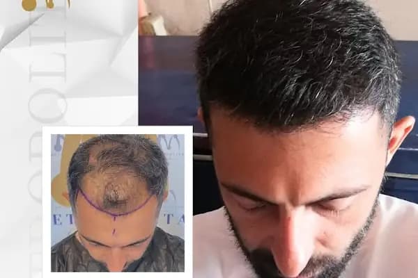 Metropolitan Saç Ekimi - Saç Transplantasyonu Kliniği - Ankara Çankaya