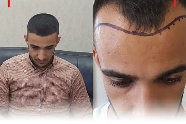 Fue Saç Ekimi Burak Karakaş - Saç Yenileme Hizmeti - Gaziantep Şahinbey