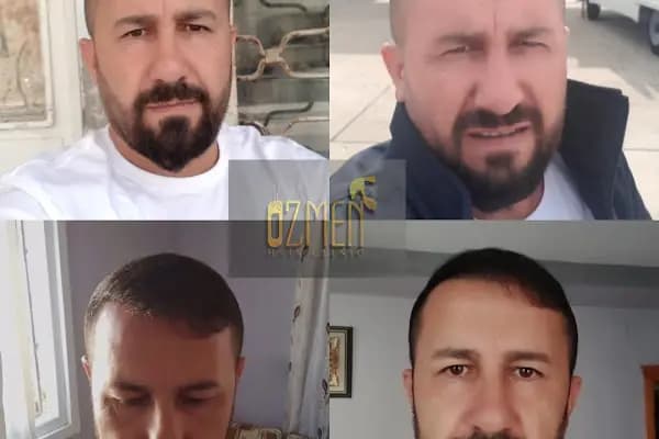 Özmen Saç Ekim , Estetik Ve Güzellik Merkezi - Saç Transplantasyonu Kliniği - Mersin Anamur