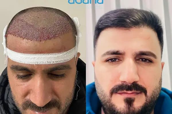 MELTEM ARGUNŞAH SAÇ EKİMİ - DHI, Sapphire &amp; Fue Hair Transplant - Saç Transplantasyonu Kliniği - Adana Çukurova