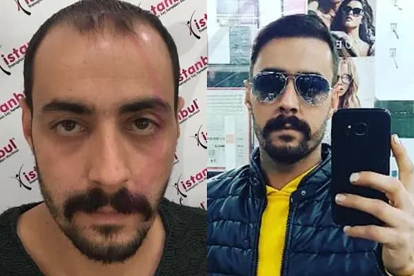 İstanbul Transplus Saç Ekim Merkezi - Saç Transplantasyonu Kliniği - Konya Meram