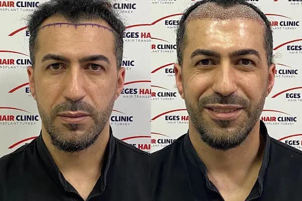 İzmir Saç Ekim Merkezi | Eges Hair Clinic - Sağlık Merkezi - İzmir Buca