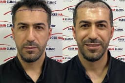 İzmir Saç Ekim Merkezi | Eges Hair Clinic