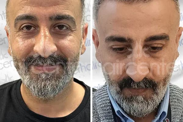 Haircenter Saç Ekim Merkezi - Saç Transplantasyonu Kliniği - İstanbul Şişli